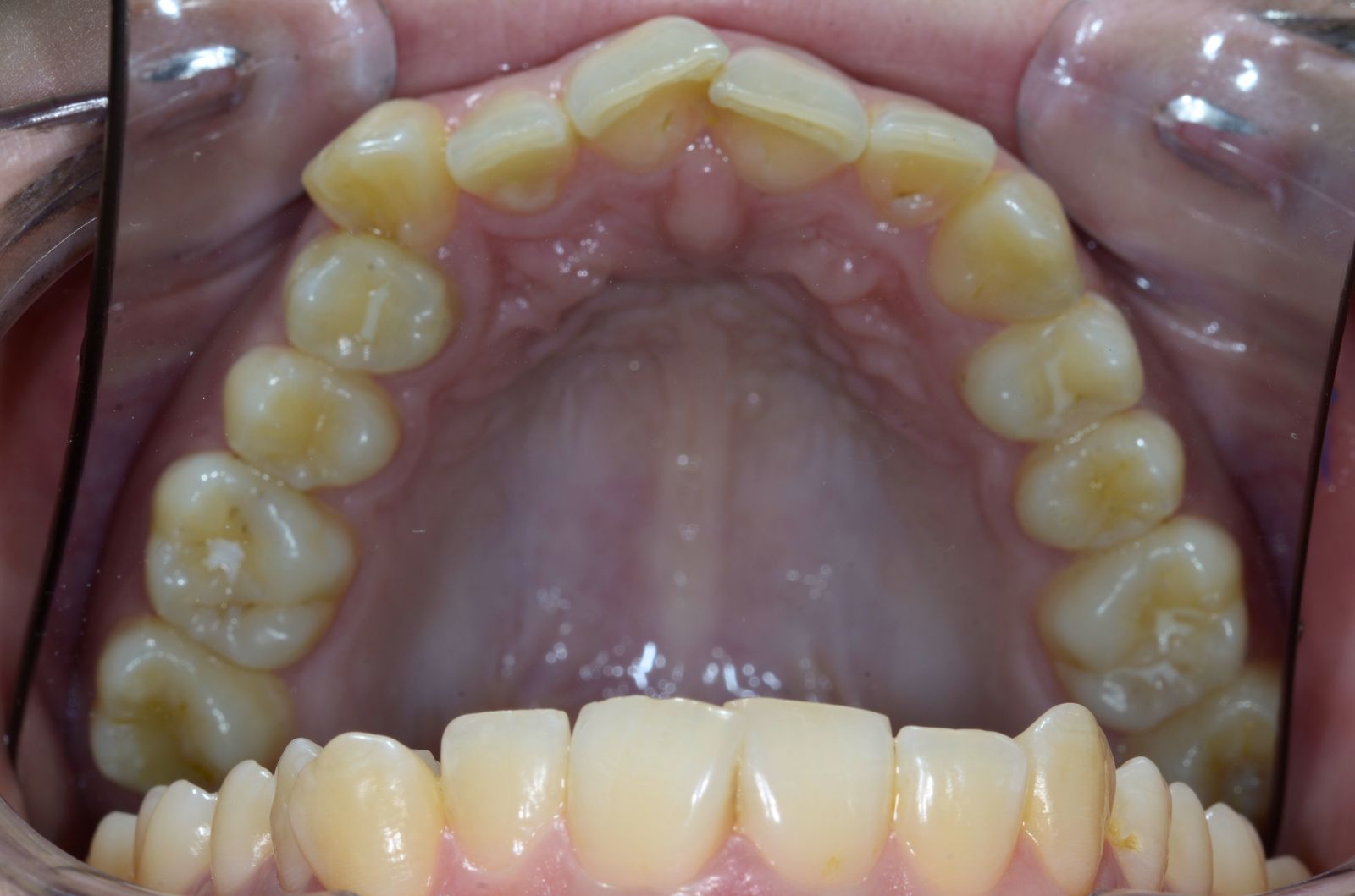 Breketai — atvejis 10