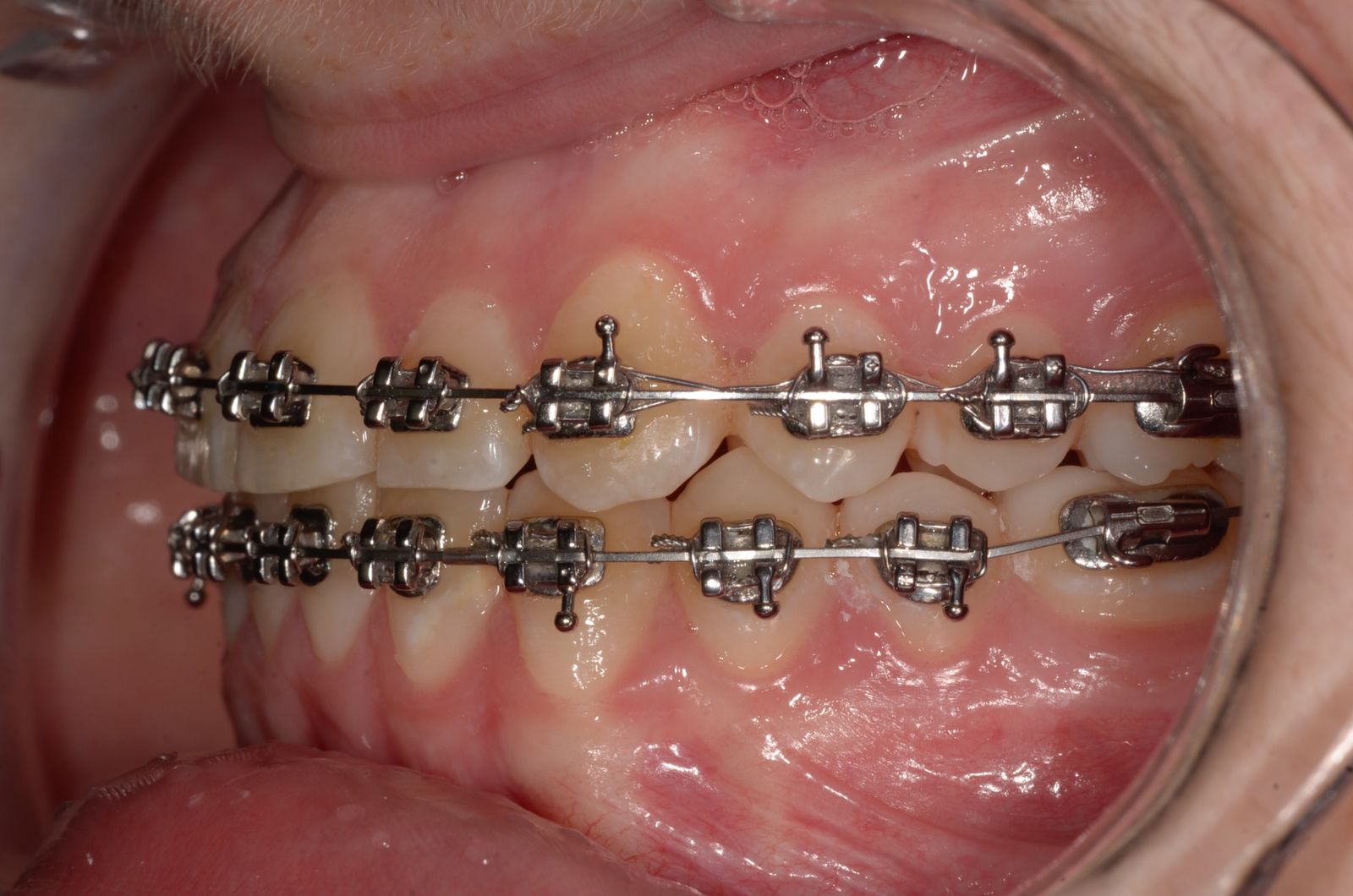 Breketai — atvejis 10