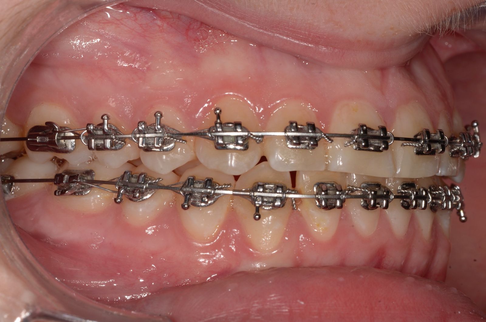 Breketai — atvejis 10